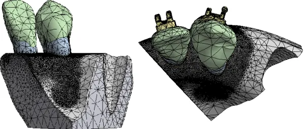 Figure 16: Isolated two-tooth substructure from the full half maxilla model, demonstrating  the fine PDL mesh size