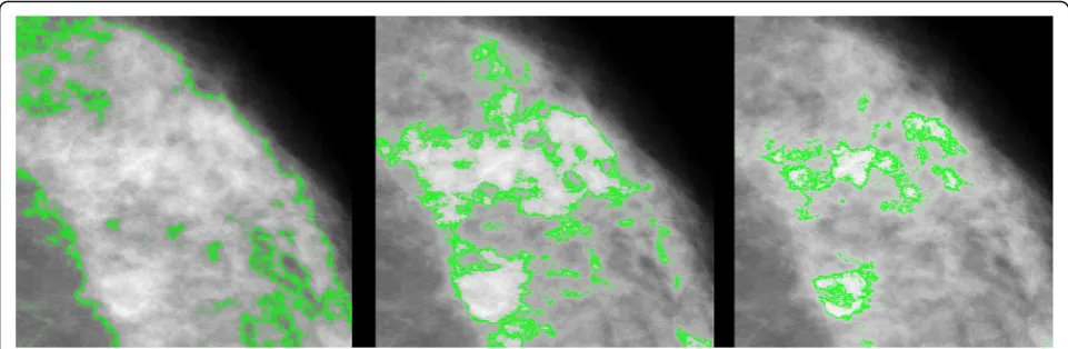 Fig. 1 Identification of dense regions (outlined in green) on the same mammogram according to the Cumulus (left panel), Altocumulus (centrepanel) and Cirrocumulus (right panel) definitions of mammographic density