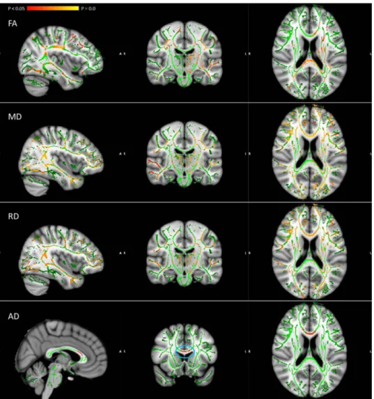 Fig. 5. DTI TBSS results. Negative correlation with early WPT learning and overall FA in siblings of COS patients; positive correlations with MD and RD; positive correlation with early WPT learning and AD in the body and genu of the corpus callosum in the 