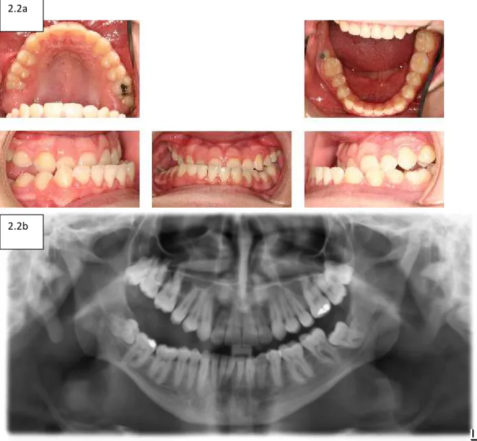 Figure 2.2- PFE results from a autosomal dominant PTH1R mutation. The classical presentation  is a progressive anterior-posterior lateral openbite shown in 2.2a and 2.2b