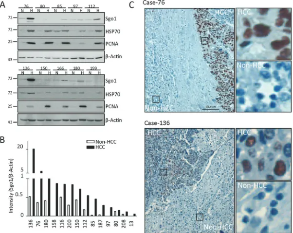 Table 2: Comparison of Sgo1 protein expression levelsa in HCC and adjacent non-HCC