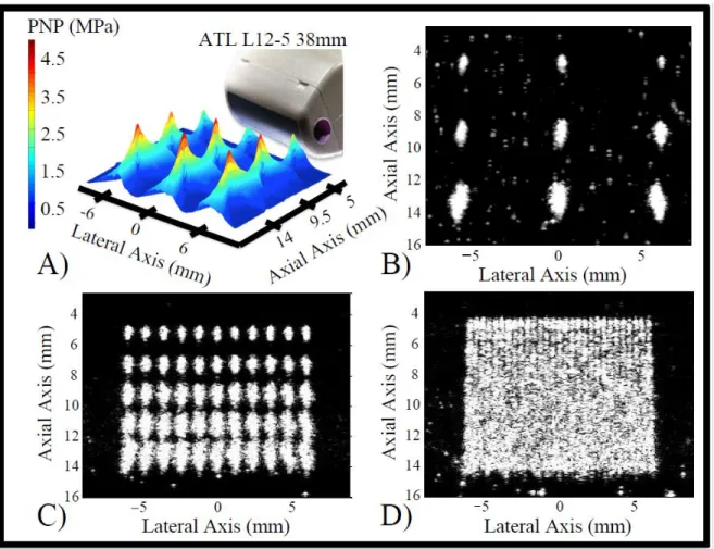 Figure 4.11. In vitro activation of DFB droplets. Changes in the magnitude and geometry of the pressure  focal zones (A) and corresponding microbubble clouds (B) at nine focal locations occur as a result of  electronically  steering  the  activation  pulse