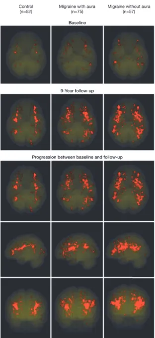 Figure 2. Geographical Location of All Individual Deep White Matter Hyperintensities Projected on Transparent 3-Dimensional  Maps  After  Normalization  of  the  Individual  Magnetic  Resonance  Scans  With  Segmented   Le-sions to Standard Montreal Neurol