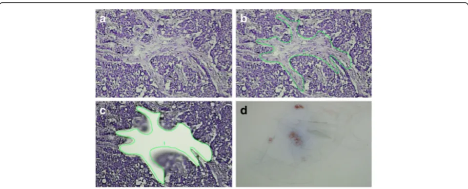 Fig. 2 Laser capture microdissection of cancer associated stroma. a–c Microdissection procedure