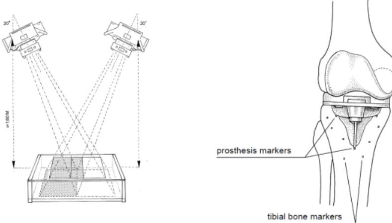 Figure 1.1: Typical RSA setup with two Roentgen foci (left) and a schematic of a knee implant with markers in the surrounding bone (right)