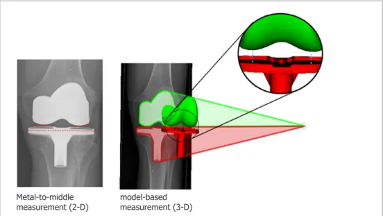 Figure 3-6.  Comparison of the measurement methods: (left) the metal-to-middle method, in  which the mJSW is obtained in teh radiograph, and (right) the MBWM in which the mJSW is  obtained semi-automatically based on 3D models
