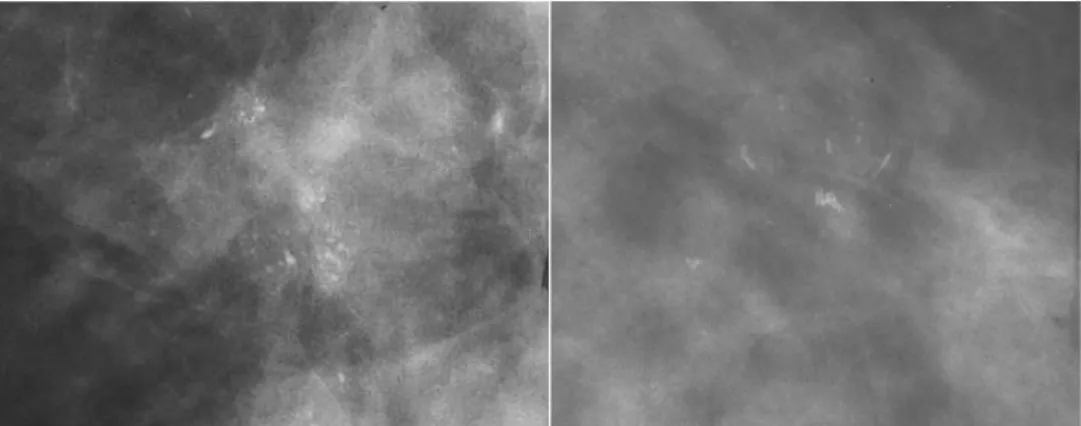 Figure 1.6 X-ray examples of calcifications typical of ductal carcinoma in  situ. Left: Granular type