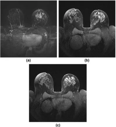 Figure 1.10 MRI breast image sequence of invasive  lobular carcinoma in the left breast
