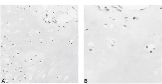 Figure 4.1: Immunohistochemical staining for the PTHR1 protein. Sample 22.1, an enchondroma of the phalanx, showing positive PTHR1 expression in both nucleus and cytoplasm of tumor cells