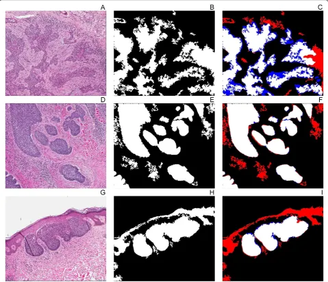 Table 2 Evaluation of the tumour extraction algorithm without colour deconvolution in BCC histology slides