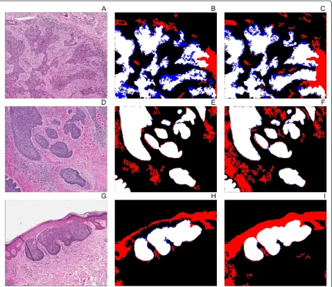 Figure 3 Application of the tumour extraction algorithm with and without colour deconvolution