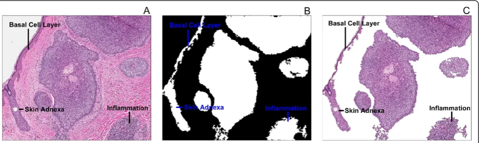 Figure 4 False positive regions identified by the tumour extraction algorithm. The basal cell layer, skin adnexa, and inflammation presentin the original image (A) were identified as cancerous in the binary file (B), and the resulting extraction (C).