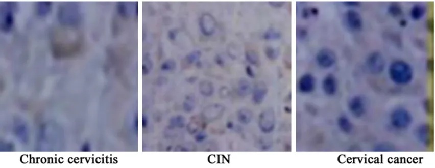 Figure 1. Immunohistochemical detection of Survivin expression in cervical tissue (×400)