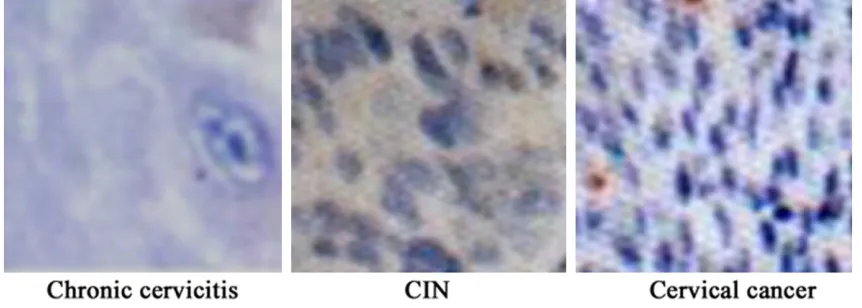 Table 3. Immunohistochemistry detection of MMP-2 and MMP-9 expression in cervical tissue 