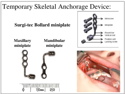 Figure 1:  Titanium miniplates and surgical procedure 