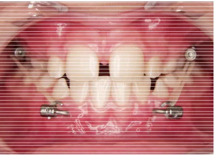 Figure 2:  Clinical technique of attaching elastics to modified miniplates  Radiographic Protocol 