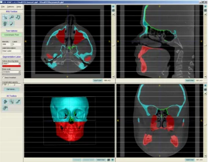Figure 3:  Segmentation process using ITK-SNAP software  Segmentation of the maxilla, mandible, and cranial base was completed using the  ITK-SNAP software 63,64  which is a freely available open-source program