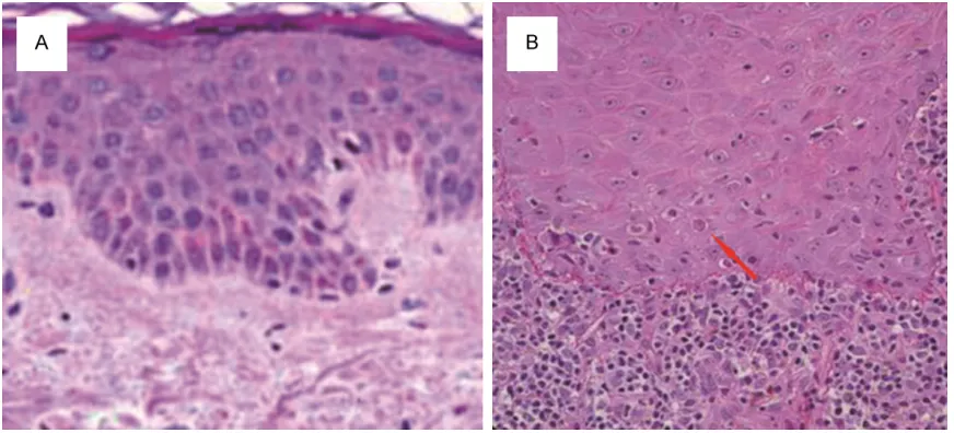Figure 1. Pathological examination of normal skin tissues and LP tissues. A. Normal skin tissues; B