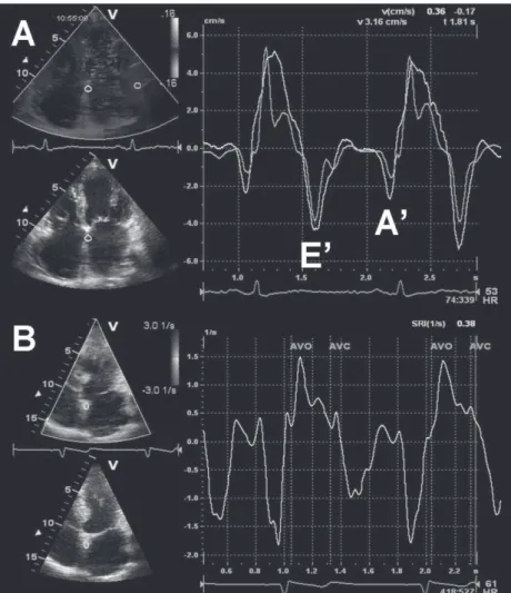 Figure 6. Panel A: Color-coded tissue Doppler imaging in the apical 4-chamber view for the assessment of regional LA function