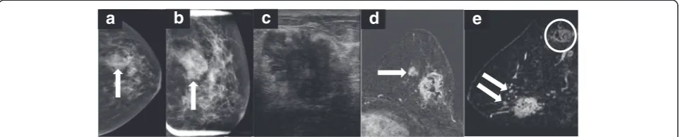 Fig. 3 A 63-year-old female presented with a palpable mass in the left breast.shadowing measuring 3.5 cm in the greatest dimension.resonance image MRI was ordered (and ultrasound