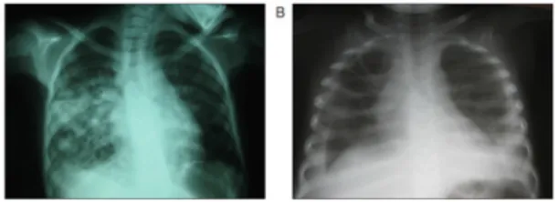 Fig 1. Representations of pulmonary KS on chest x-ray in patients with classic hyperpigmented KS skin lesions