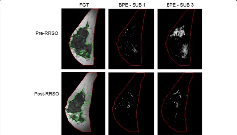 Fig. 4 Representative examples of fibroglandular tissue (FGT) and background parenchymal enhancement (BPE) from a magnetic resonanceimaging (MRI) slice obtained pre-RRSO and post-RRSO in a woman who did not develop breast cancer after undergoing risk-reduc