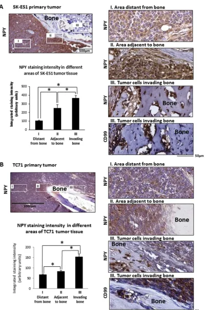 Figure 4: Induction of NPY expression in areas of bone invasion within ES primary tumors