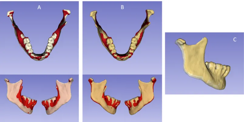 Fig 5. 3D surface models overlays: red model, T1; white model, T2 from mandibular body mask registration; yellow model, T2 from modified Björk mask registration