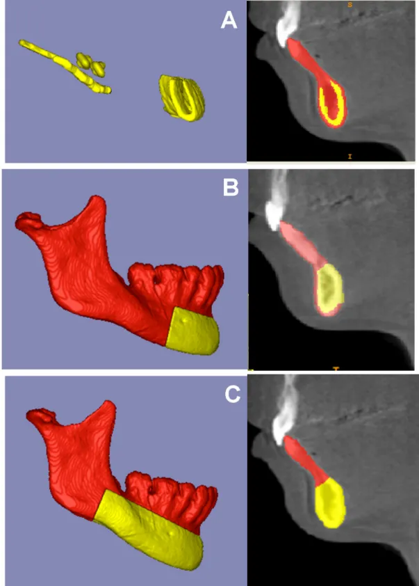 Fig 3. Figures that represent the masks (regions of reference) used for mandibular voxel-based registrations.