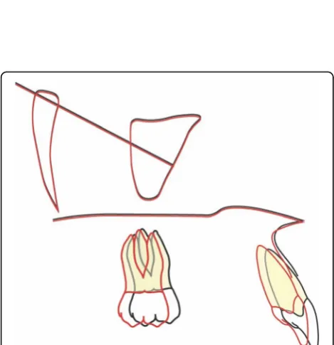 Fig. 13 Superimposition of the mandible. The stable anatomicalstructures of the mandible are: • The anterior contour of the chin.• The inner cortical structure at the inferior border of the symphysis.• Trabecular structures related to the mandibular canal [10]