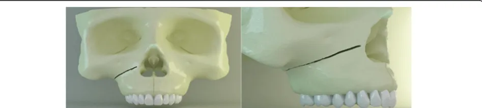 Fig. 1 Cortical bone layer, spongious bone, maxillary sinus, andteeth from the sagittal view