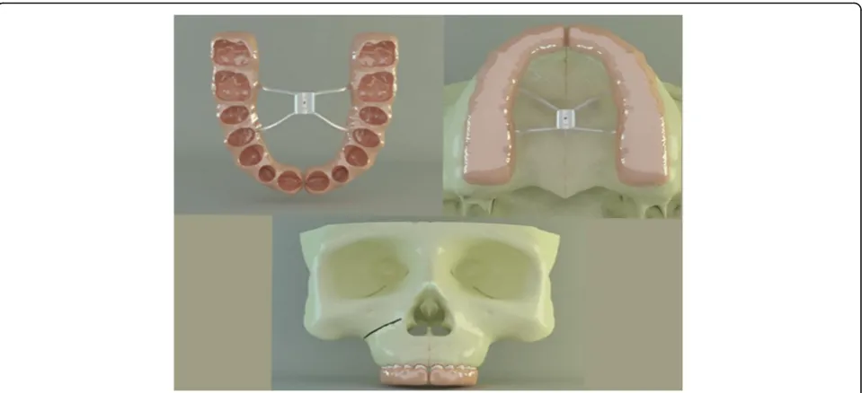 Fig. 4 Final finite element model used in the study