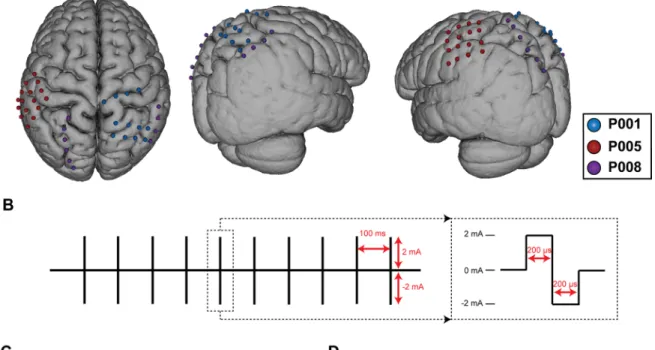 Fig 3. Electrode Locations and Artifact Suppression. (A) Surface model of an atlas brain showing locations of electrodes over the parietal regions in each of the three patients