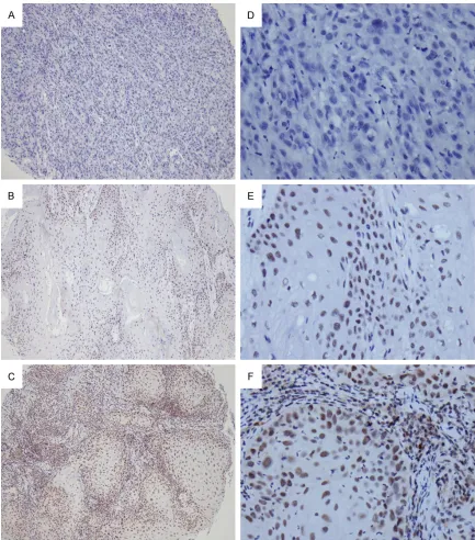 Figure 1. CREB-binding protein (CBP) in primary oral cancer. Tissue microarrays of primary oral squamous cell carci-nomas (OSCCs) (276) were immunohistochemically analyzed for CBP