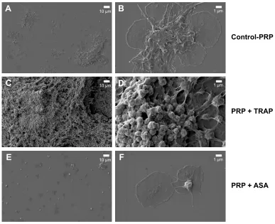 Figure 2 Quartz crystal microbalance with dissipation. Effects of TRAP and ASA on platelet microaggregation.Notes: (A) Quantitative analysis of the effects of TRAP on frequency f and energy dissipation D