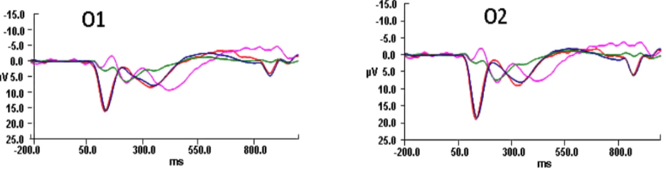Figure 8:  ERPS for both deviant nontarget and deviant target stimulus conditions in children and  adults at electrodes O1 and O2 only.