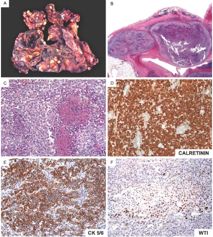 Figure 2. Gross pathology and histological analysis of tumor tissue shows malignant pleural epithelial mesothelio-ma