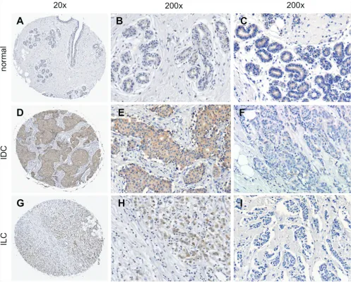 Figure 1: Immunohistological detection of sortilin in breast cancers. The expression of sortilin was assessed by immunohistochemistry in a series of invasive breast cancers and normal adjacent tissues