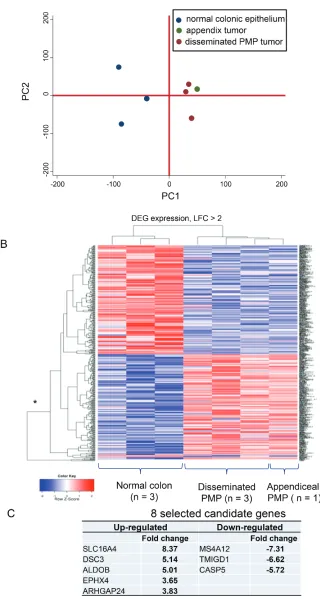 Figure 2: Exon array analysis identified 27 up-regulated and 34 down-regulated genes in PMP epithelial tissue ( pdistinctive clustering between normal and neoplastic tissue in the principal component analysis and bars