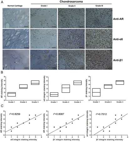Figure 6: The expression levels of AR and α6β1 integrin are positively correlated with histopathological grade in human chondrosarcoma tissues