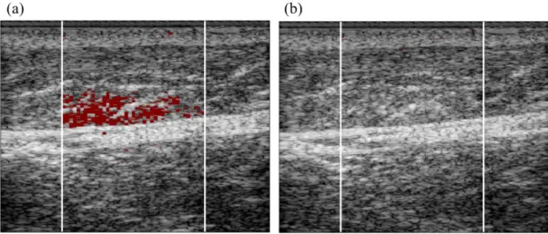 Figure 3.3: Comparison between hemorrhage detection with different beam sequences. The push  sequence used an ARFI excitation impulse followed by 60 conventional, tracking A-lines (a)