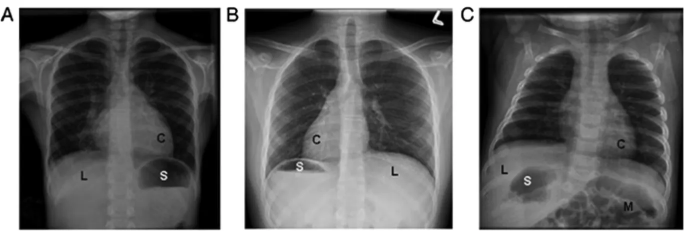 Fig. 1. Examples of various laterality defects on radiology imaging in PCD. Different situs arrangements found in PCD, including (A) a participant with situs solitus, or normal organ arrangement, with left cardiac apex, left-sided stomach bubble, and right