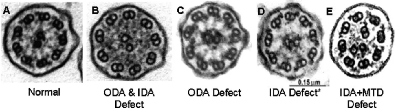 Fig. 2. Electron microscopy findings in primary ciliary dyskinesia. Diagnostic ciliary electron microscopy findings in primary ciliary dyskinesia