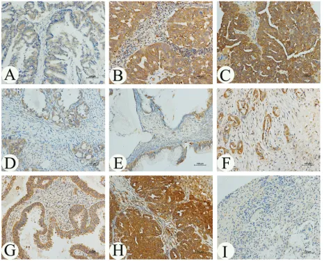 Figure 1: Immunohistochemical analysis of MARCH7 in the (papillary adenocarcinoma (stage I); ((IB) ; (adenocarcinoma(stage III); (expression in ovarian cancer