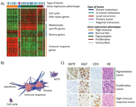 Figure 1: Gene expression phenotypes in melanoma. ) Heatmap of 299 genes (rows) included in the classification of 214 analysis identified five clusters of genes reflecting biological mechanisms of relevance in melanoma and named thereafter