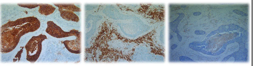Figure 2: stable cd70 protein expression in paired primary and metastatic nsclc tissue