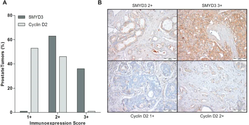 Figure 7: Immunoexpression of SMYD3 and Cyclin D2 in prostate cancer tissues. A. Distribution of SMYD3 and Cyclin D2 immunoexpression in 150 primary prostate cancer tissues according to immunoscore [1+ (expression lower than in normal prostate tissue), 2+ 
