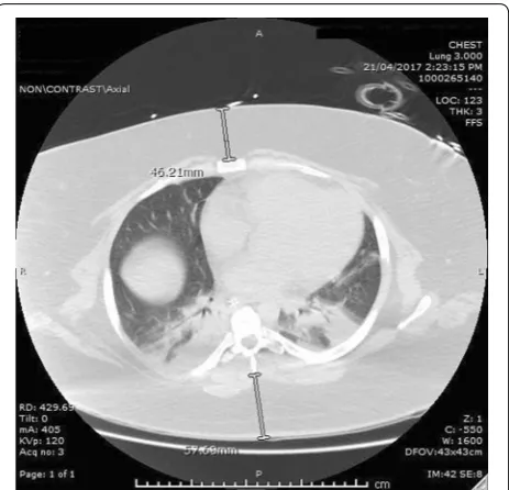 Fig. 1 Example CT thorax image demonstrating sites at which meas-urement of SAT were made in the anterior–posterior plane