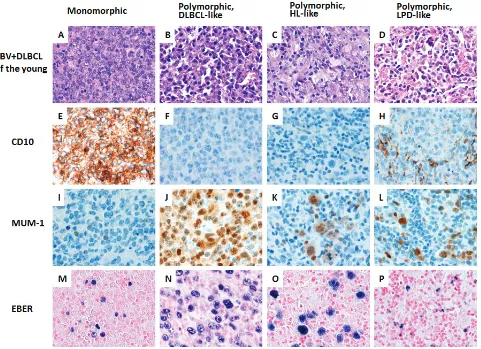 Figure 2: A spectrum of morphologic variants and immunophenotypic profiling in EBV-positive diffuse large B-cell lymphoma of the younger patients