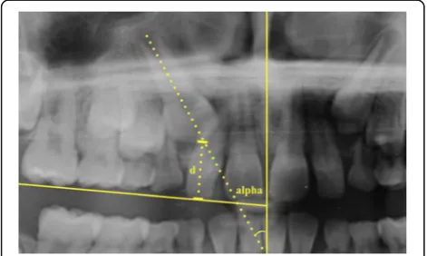 Fig. 1 Diagrammatic representation of the most common sectors ofthe impacted canine [5]